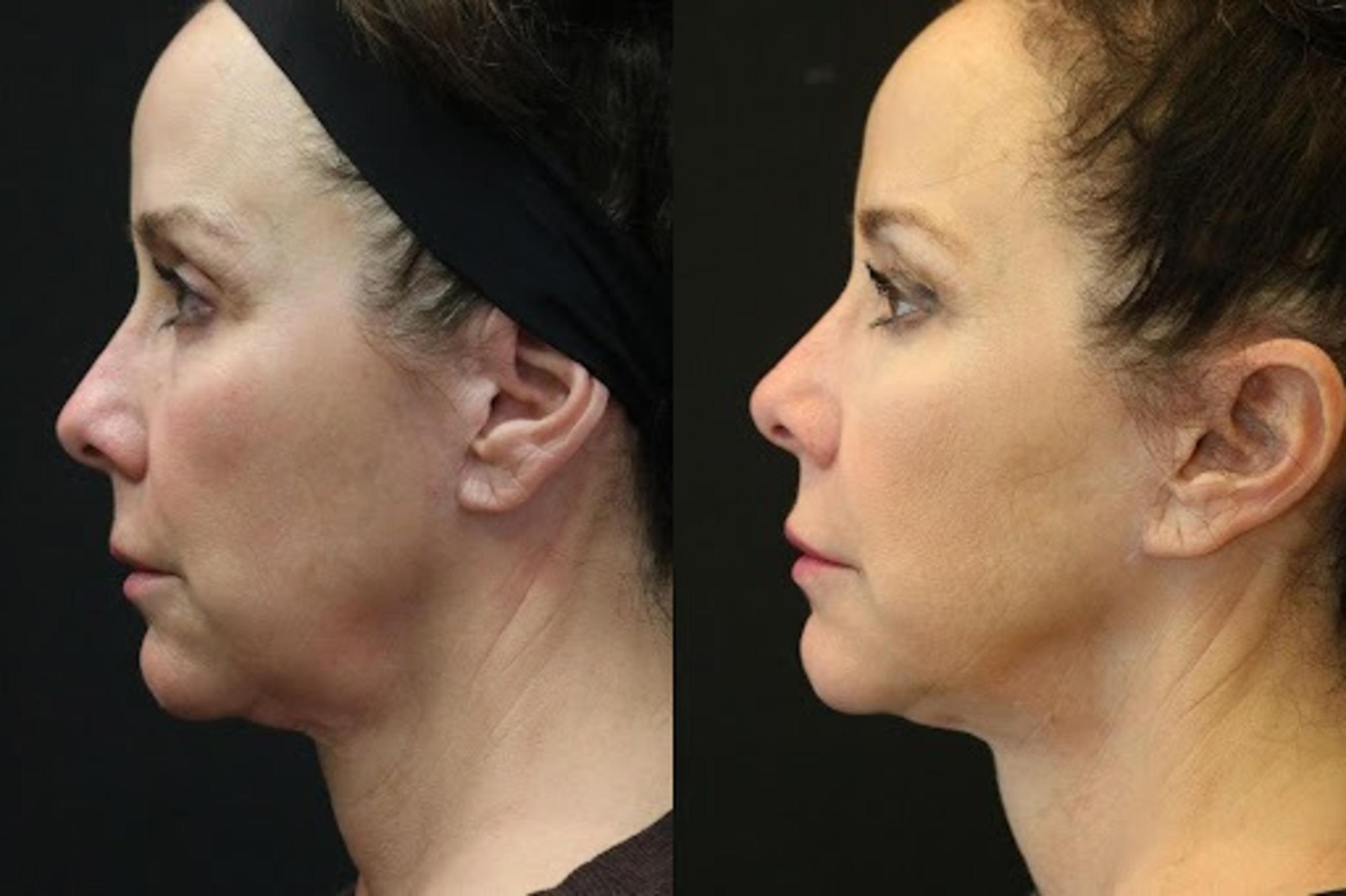 Before & After Facelift & Neck Lift Case 277 View 2 View in Santa Rosa, California