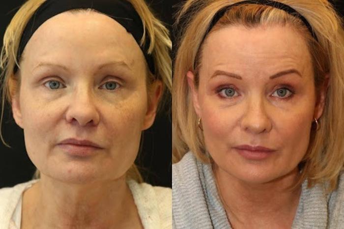 Before & After Facelift & Neck Lift Case 287 View 1 View in Santa Rosa, California
