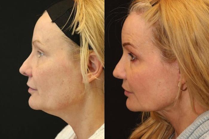 Before & After Facelift & Neck Lift Case 287 View 2 View in Santa Rosa, California