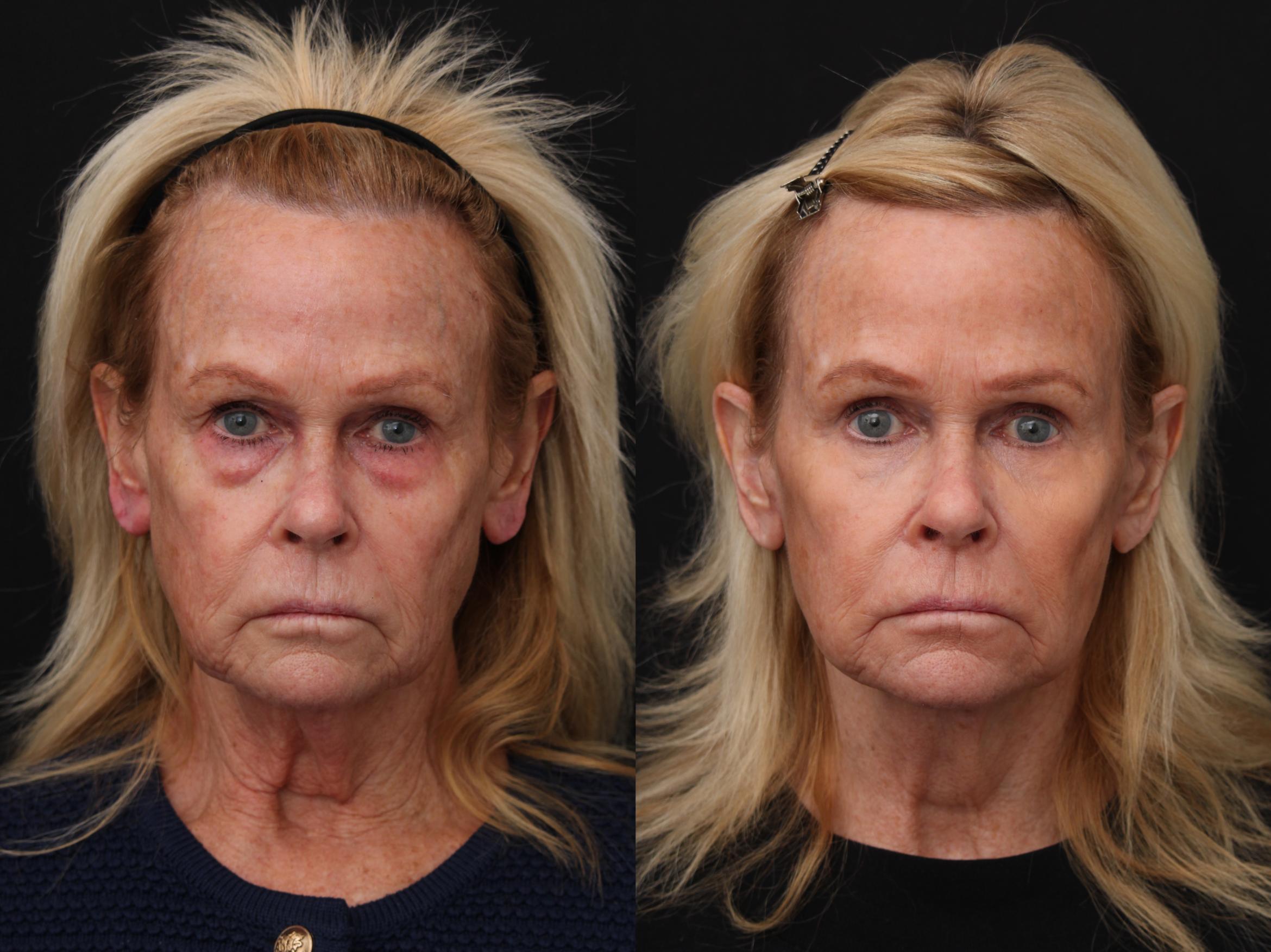 Before & After Eyelid Lift Case 297 View 1 View in Santa Rosa, California