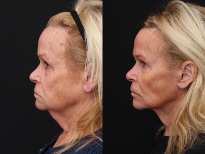 Before & After Eyelid Lift Case 297 View 2 View in Santa Rosa, California