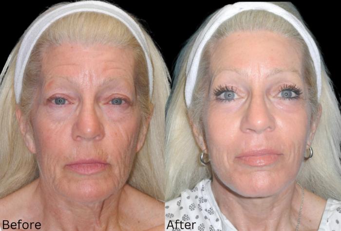 Before & After Facelift & Neck Lift Case 38 View 1 View in Santa Rosa, California