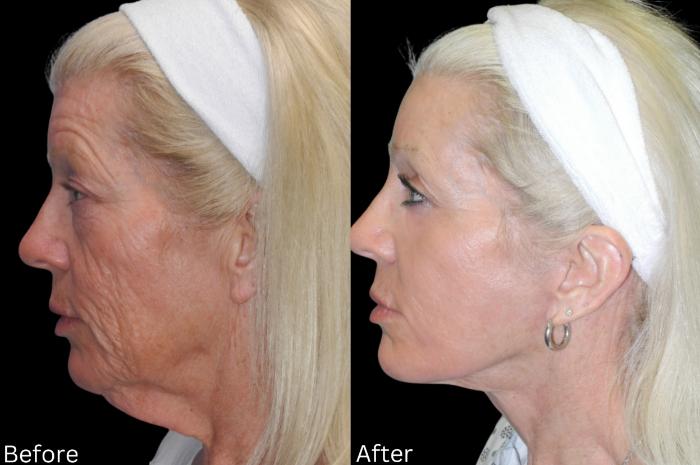 Before & After Facelift & Neck Lift Case 38 View 2 View in Santa Rosa, California