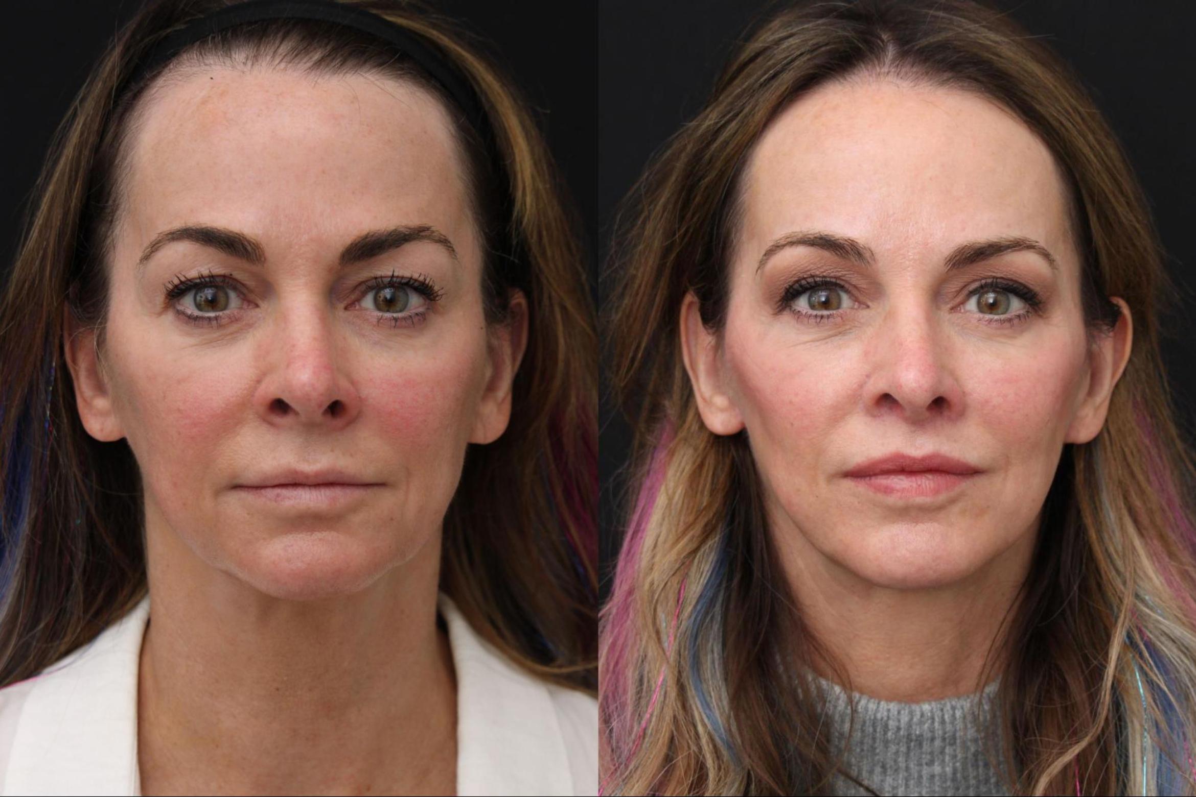 Before & After Facelift & Neck Lift Case 386 View 1 View in Santa Rosa, California