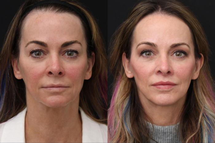 Before & After Facelift & Neck Lift Case 386 View 1 View in Santa Rosa, California