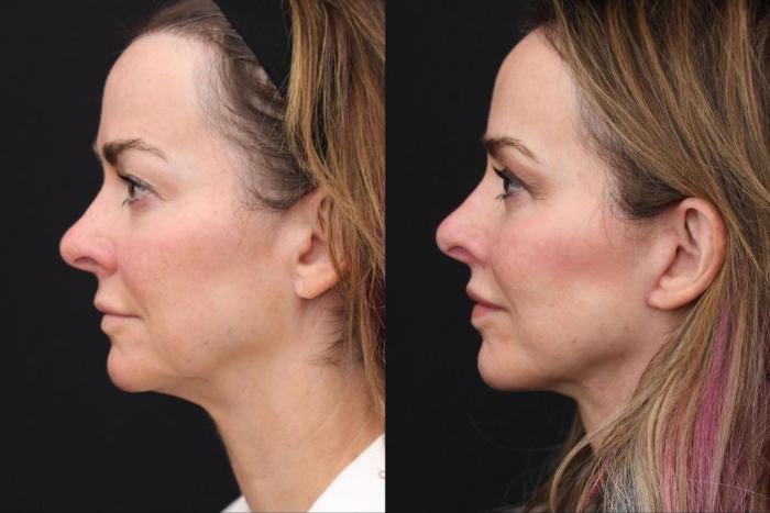 Before & After Facelift & Neck Lift Case 386 View 2 View in Santa Rosa, California