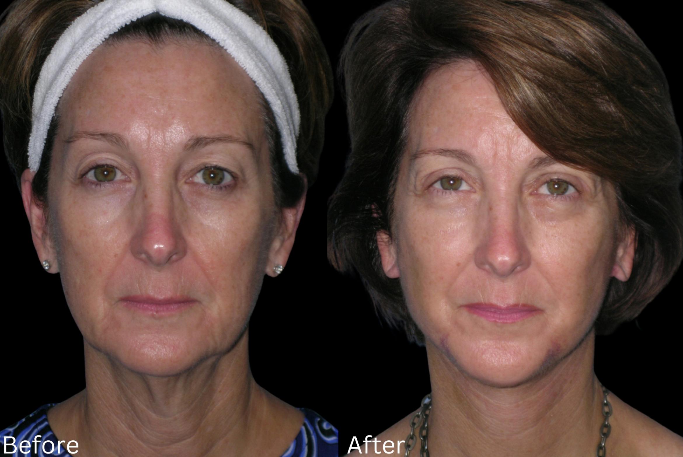 Before & After Facelift & Neck Lift Case 39 View 1 View in Santa Rosa, California