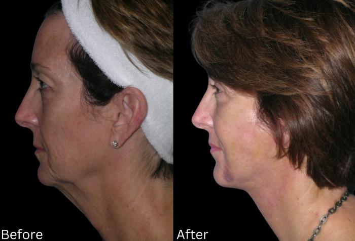 Before & After Facelift & Neck Lift Case 39 View 2 View in Santa Rosa, California