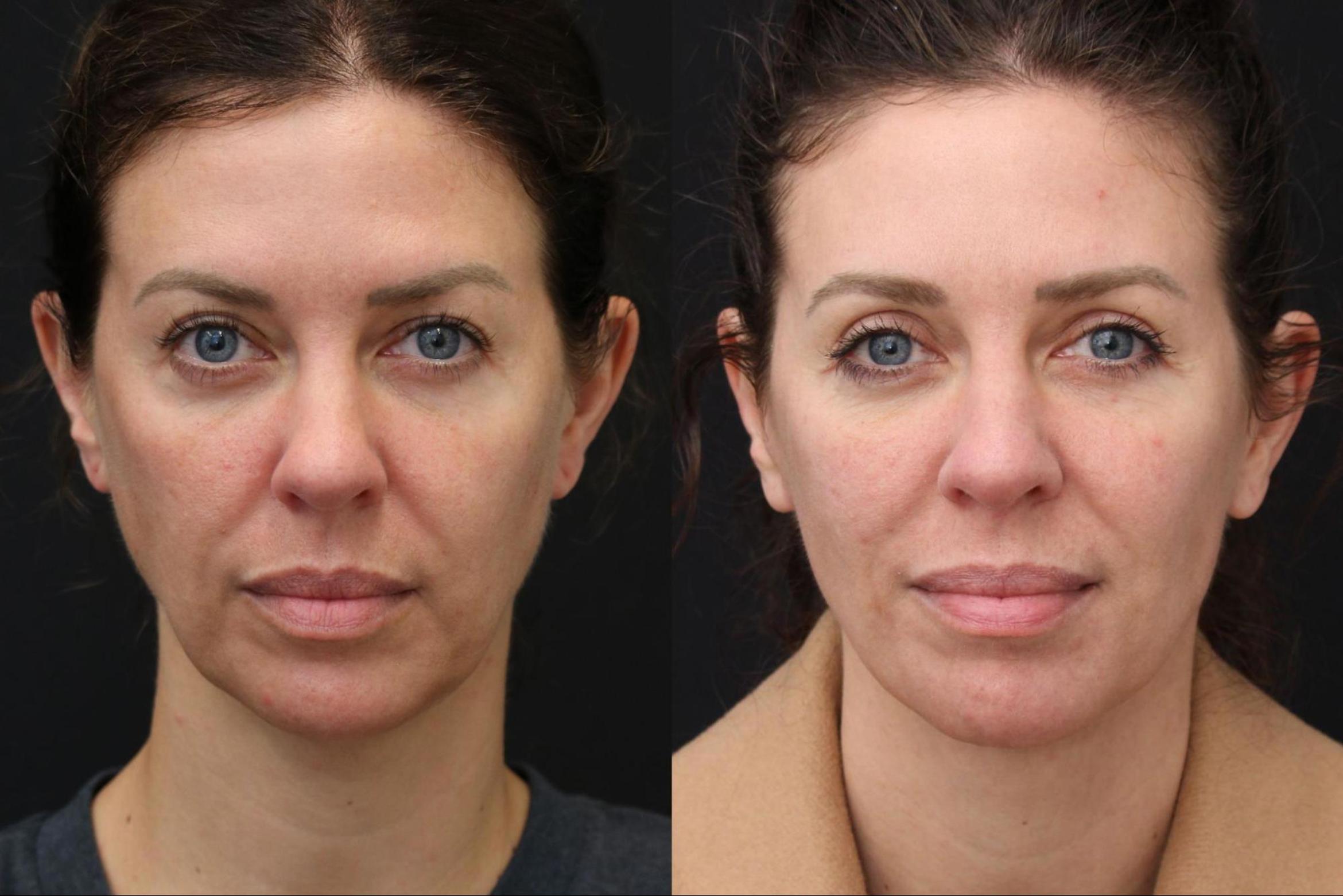 Before & After Facelift & Neck Lift Case 395 View 1 View in Santa Rosa, California