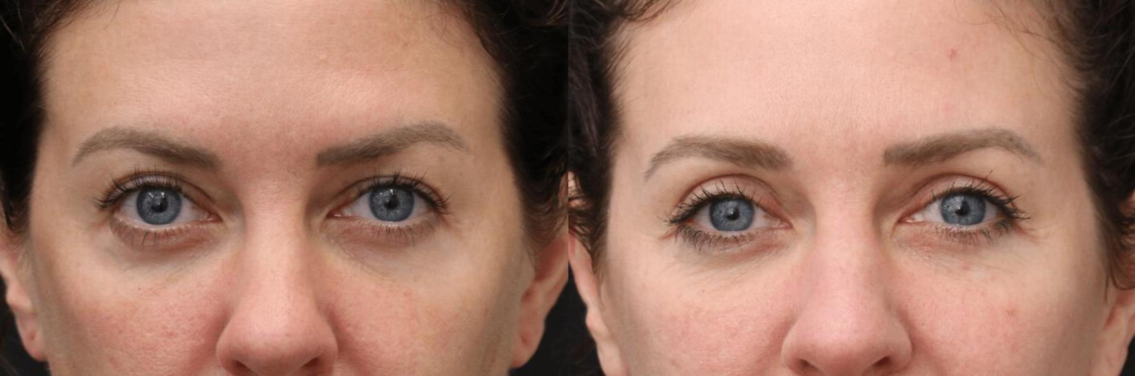 Before & After Facelift & Neck Lift Case 395 View 2 View in Santa Rosa, California