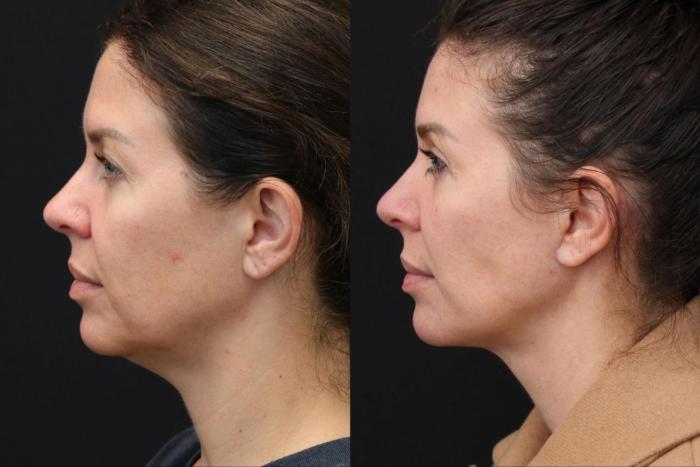Before & After Facelift & Neck Lift Case 395 View 3 View in Santa Rosa, California