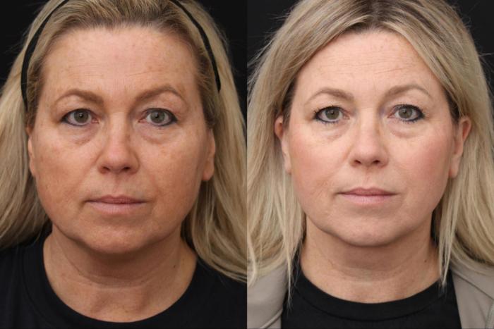 Before & After Facelift & Neck Lift Case 396 View 1 View in Santa Rosa, California