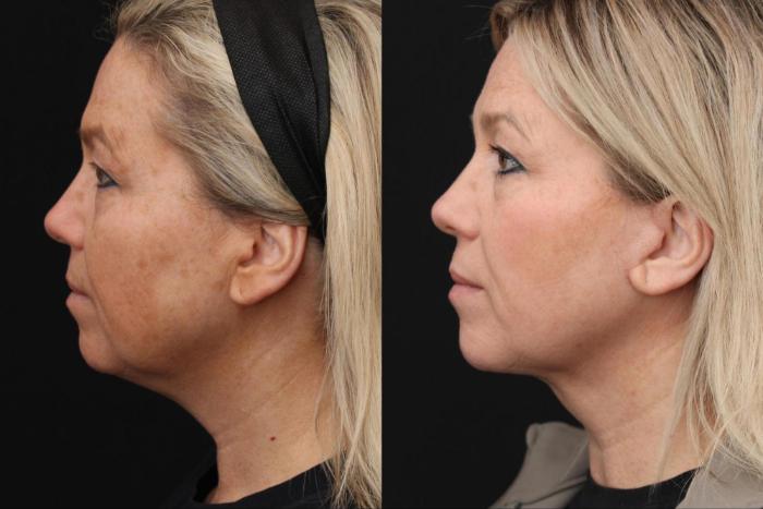 Before & After Facelift & Neck Lift Case 396 View 2 View in Santa Rosa, California