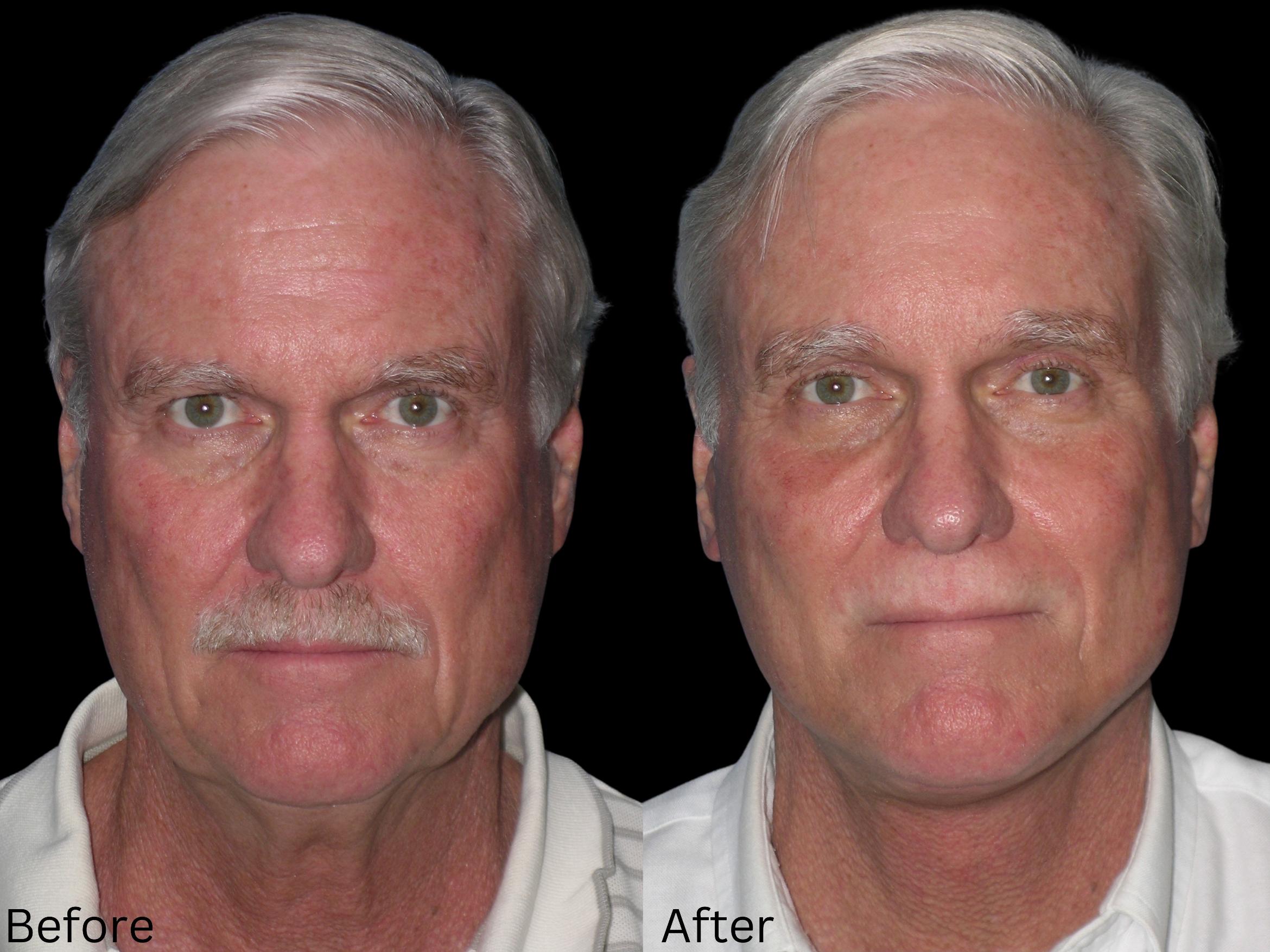 Before & After Facelift & Neck Lift Case 40 View 1 View in Santa Rosa, California