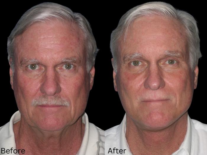 Before & After Facelift & Neck Lift Case 40 View 1 View in Santa Rosa, California