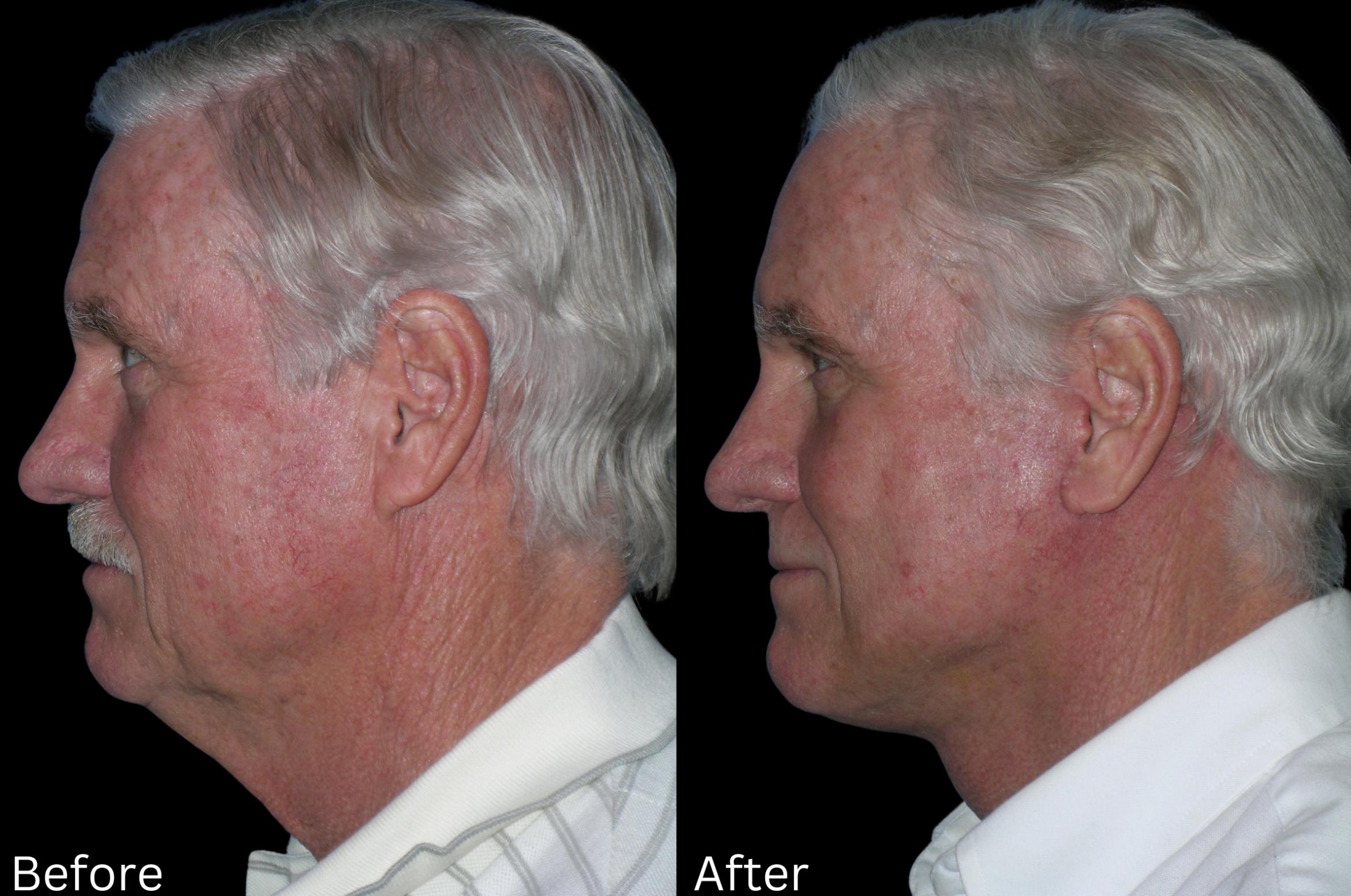 Before & After Facelift & Neck Lift Case 40 View 2 View in Santa Rosa, California