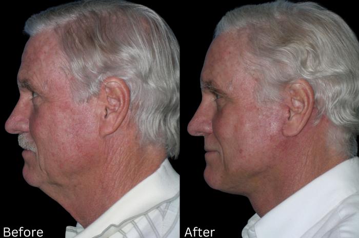 Before & After Facelift & Neck Lift Case 40 View 2 View in Santa Rosa, California
