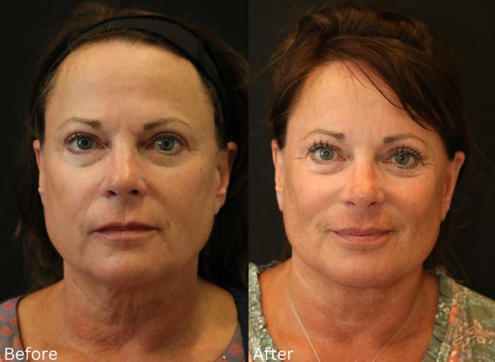 Before & After Facelift & Neck Lift Case 41 View 1 View in Santa Rosa, California