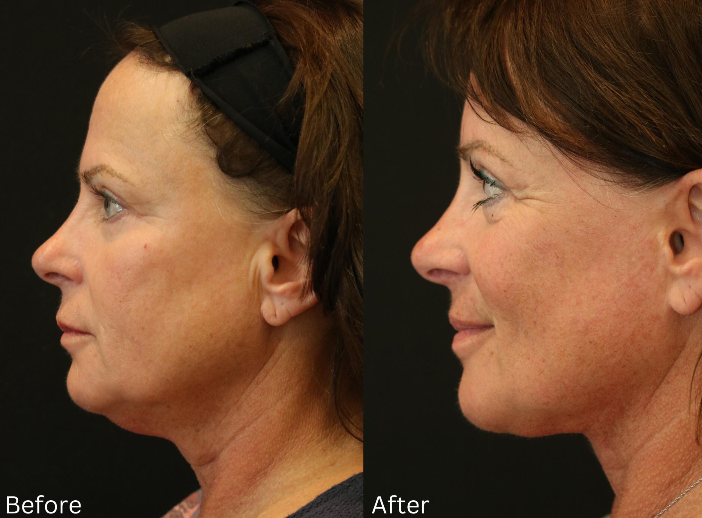 Before & After Facelift & Neck Lift Case 41 View 2 View in Santa Rosa, California