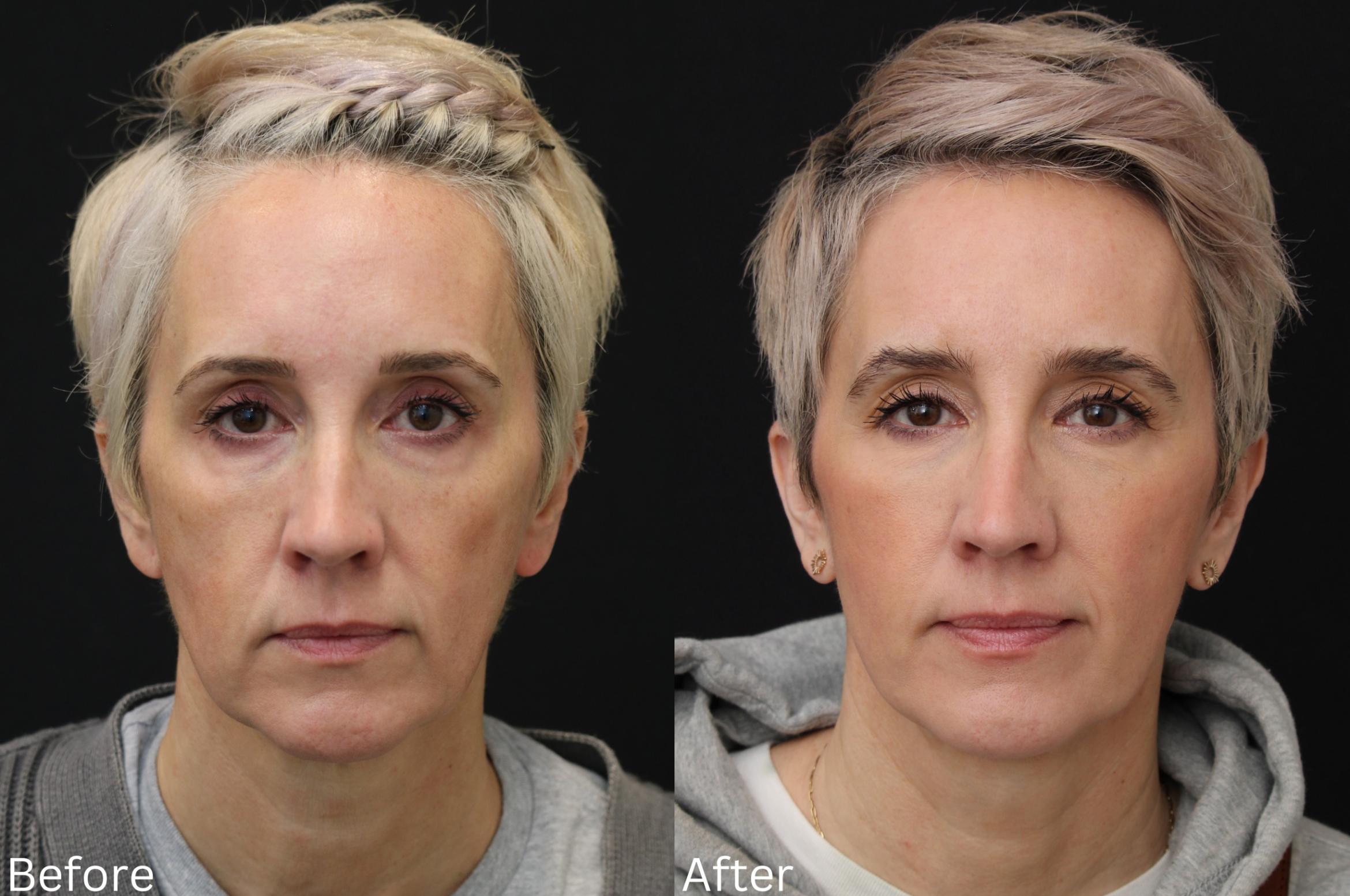 Before & After Facelift & Neck Lift Case 42 View 1 View in Santa Rosa, California