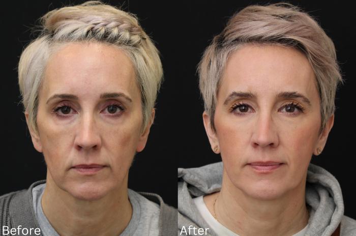 Before & After Facelift & Neck Lift Case 42 View 1 View in Santa Rosa, California