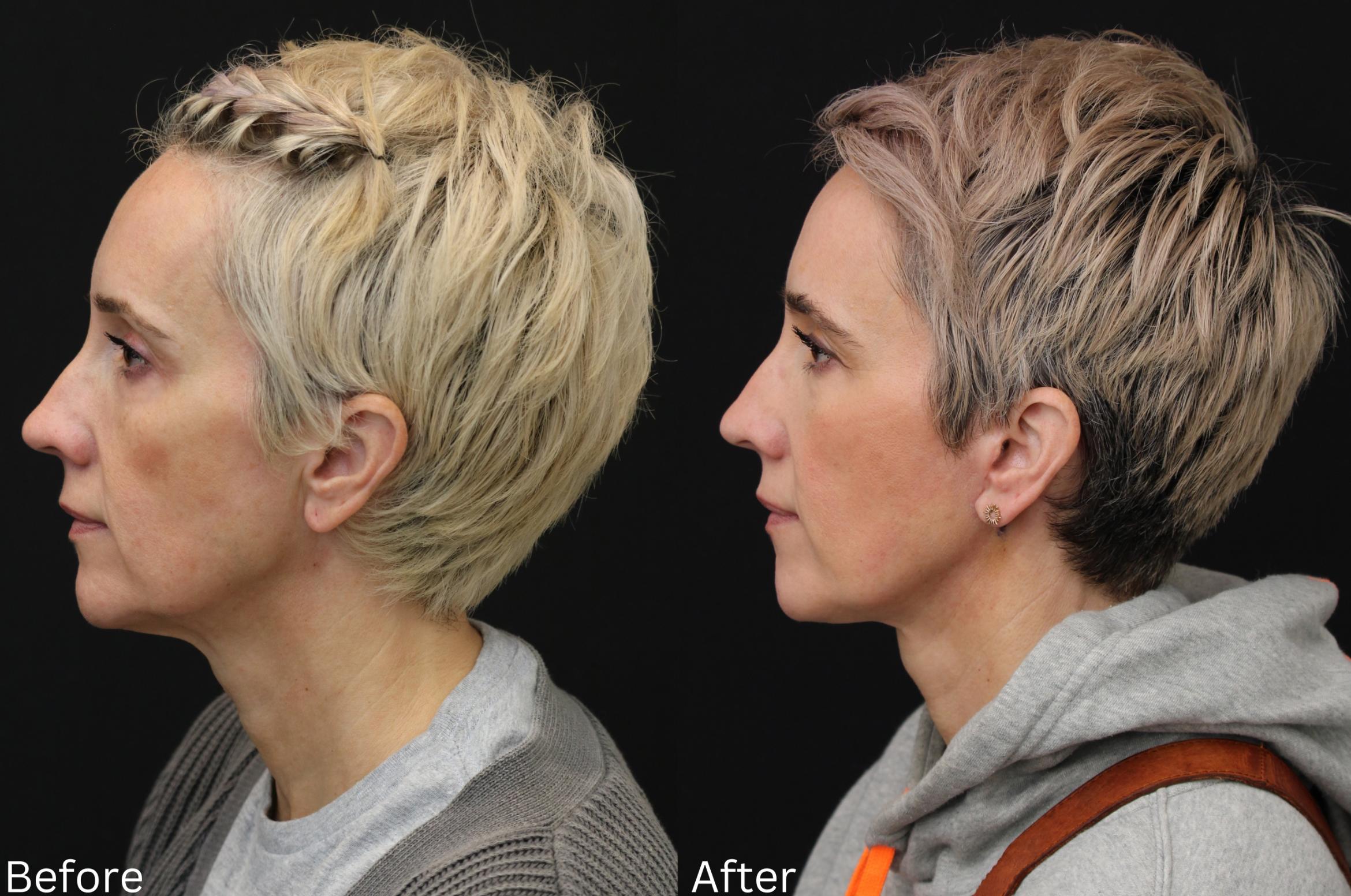 Before & After Facelift & Neck Lift Case 42 View 2 View in Santa Rosa, California