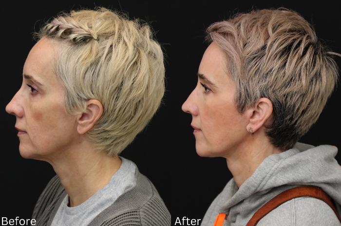 Before & After Facelift & Neck Lift Case 42 View 2 View in Santa Rosa, California