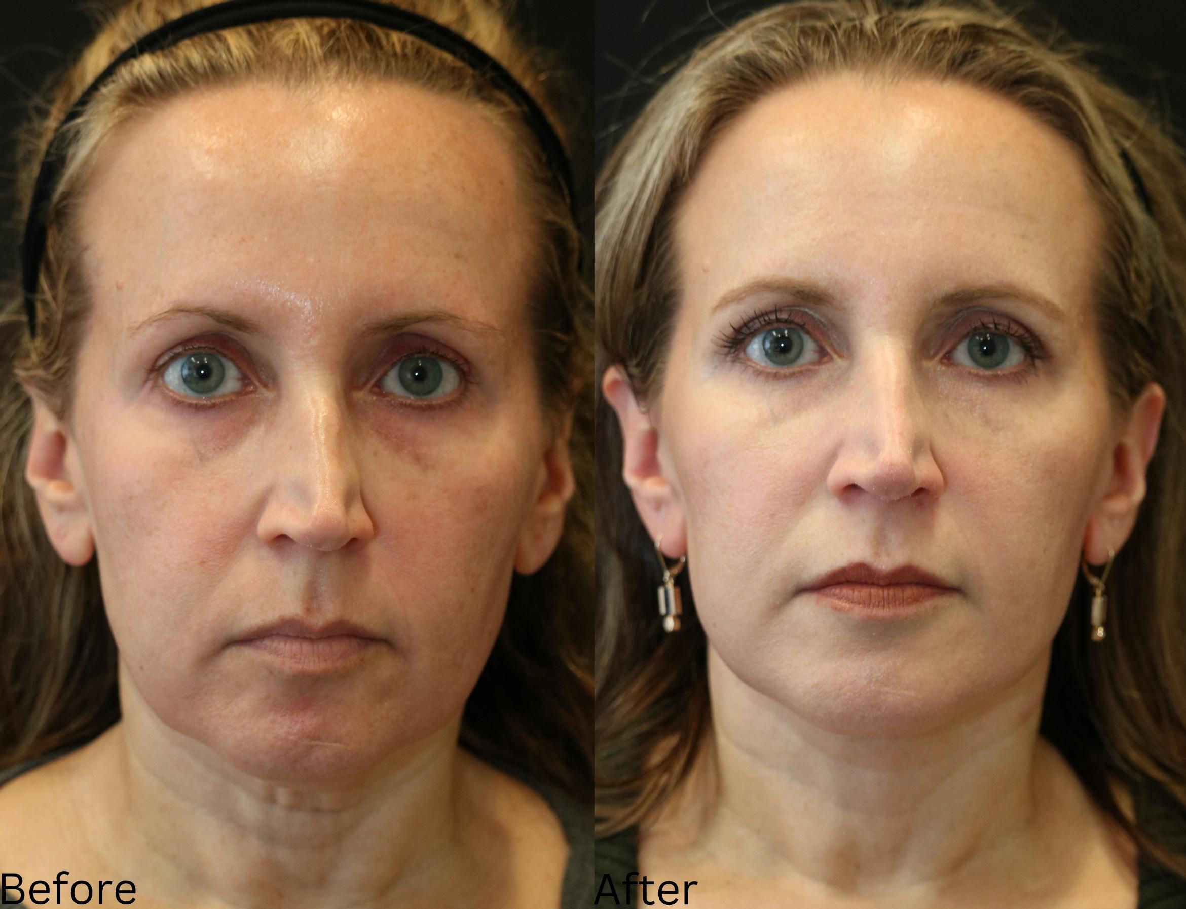Before & After Facelift & Neck Lift Case 43 View 1 View in Santa Rosa, California