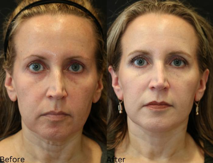 Before & After Facelift & Neck Lift Case 43 View 1 View in Santa Rosa, California