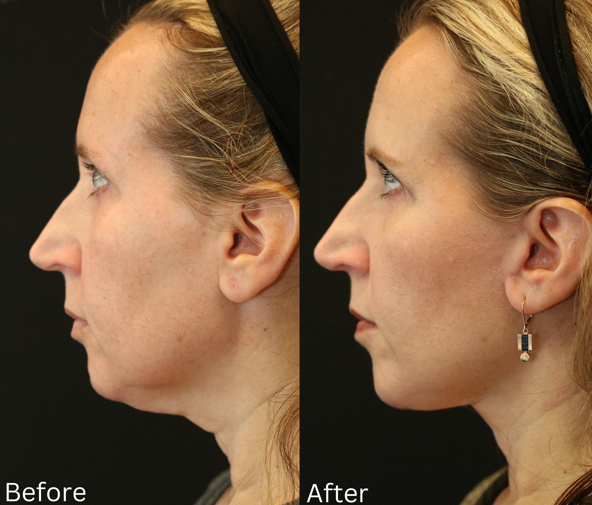 Before & After Facelift & Neck Lift Case 43 View 2 View in Santa Rosa, California