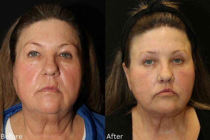 Before & After Facelift & Neck Lift Case 44 View 1 View in Santa Rosa, California