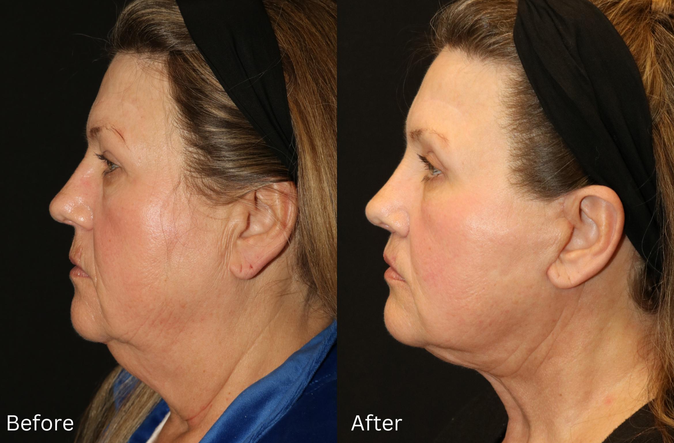 Before & After Facelift & Neck Lift Case 44 View 2 View in Santa Rosa, California