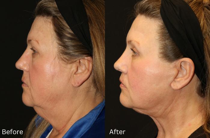 Before & After Facelift & Neck Lift Case 44 View 2 View in Santa Rosa, California