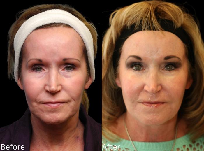 Before & After Facelift & Neck Lift Case 45 View 1 View in Santa Rosa, California