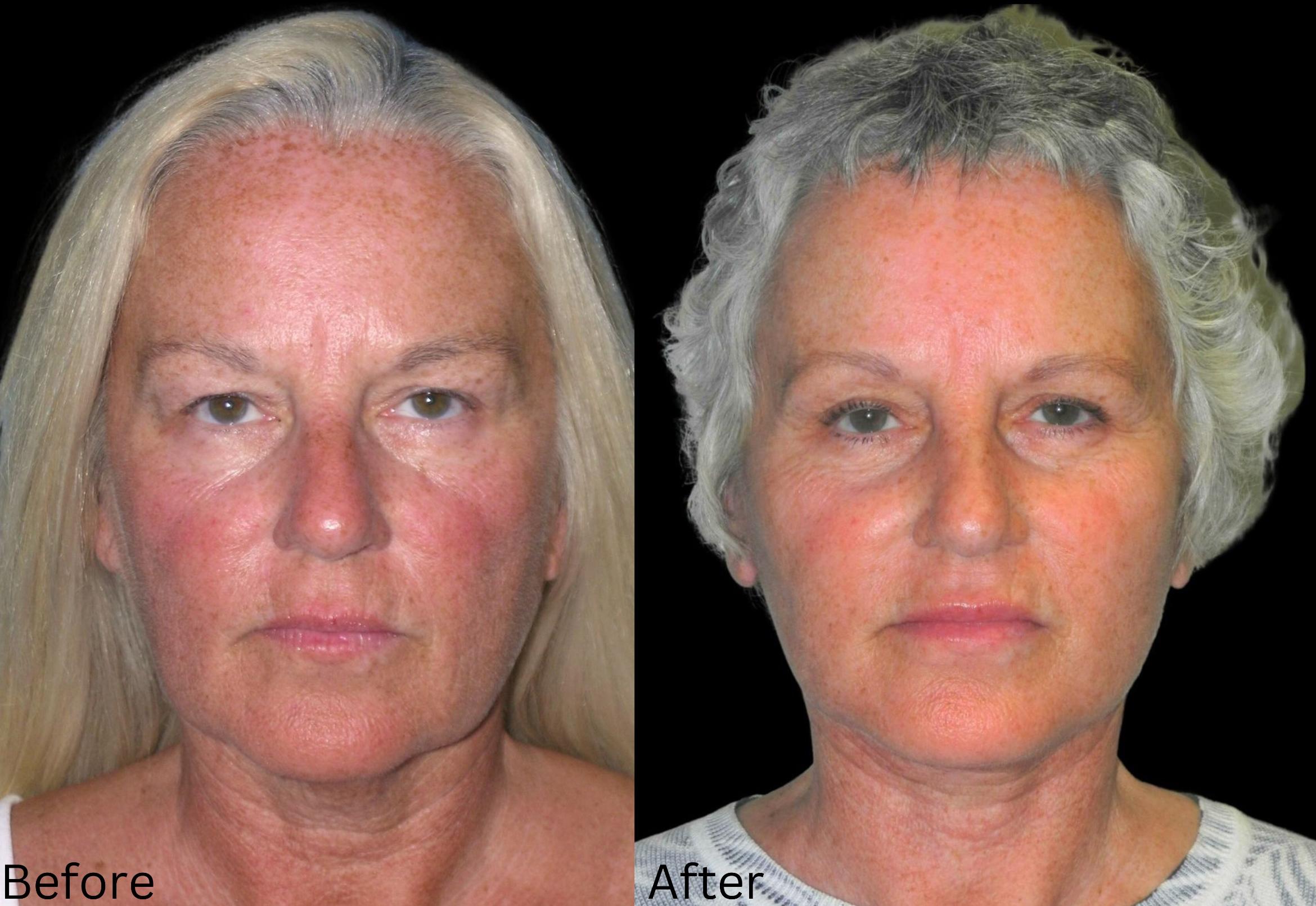 Before & After Facelift & Neck Lift Case 46 View 1 View in Santa Rosa, California