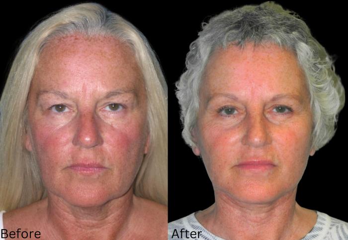 Before & After Facelift & Neck Lift Case 46 View 1 View in Santa Rosa, California