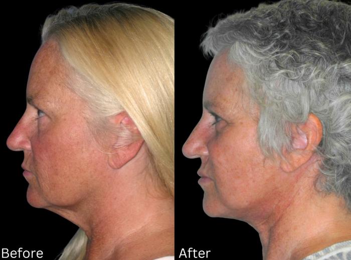 Before & After Facelift & Neck Lift Case 46 View 2 View in Santa Rosa, California