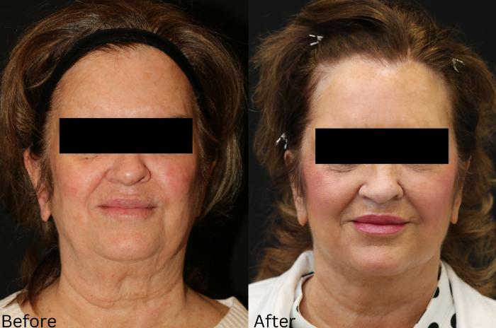 Before & After Facelift & Neck Lift Case 47 View 1 View in Santa Rosa, California