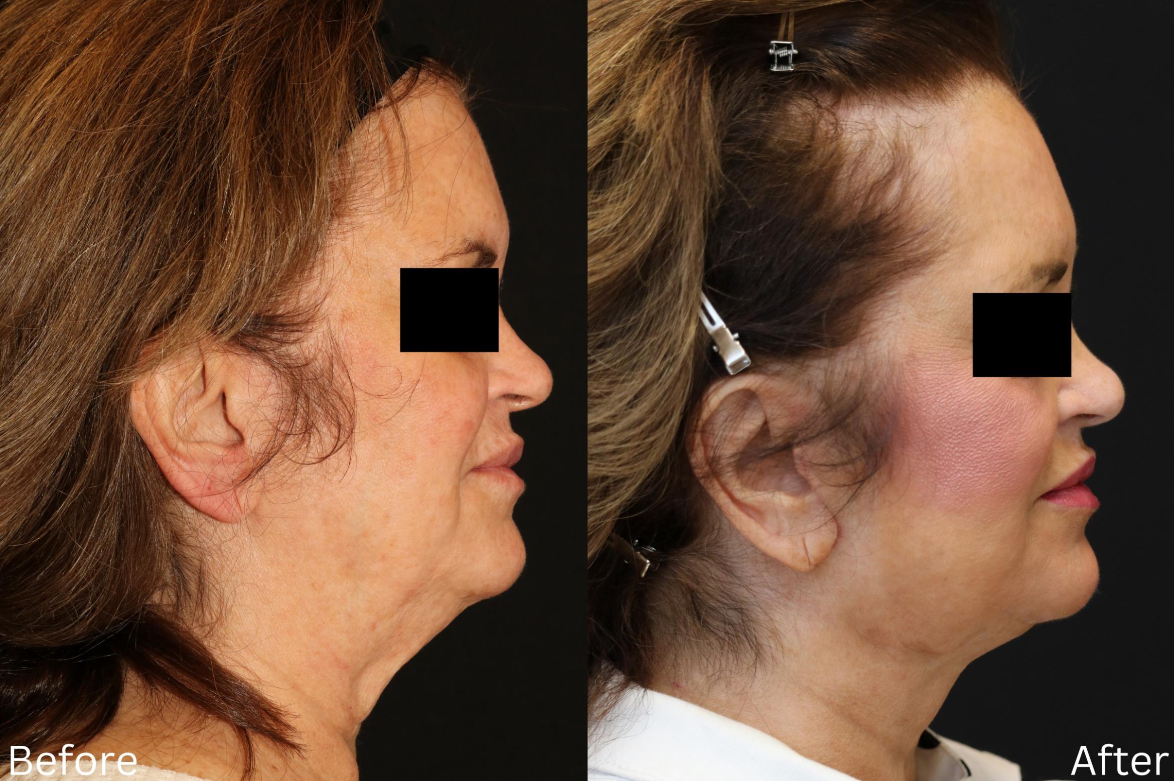 Before & After Facelift & Neck Lift Case 47 View 2 View in Santa Rosa, California
