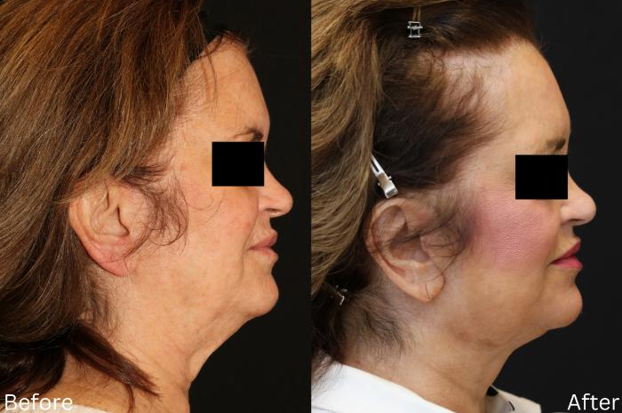 Before & After Facelift & Neck Lift Case 47 View 2 View in Santa Rosa, California