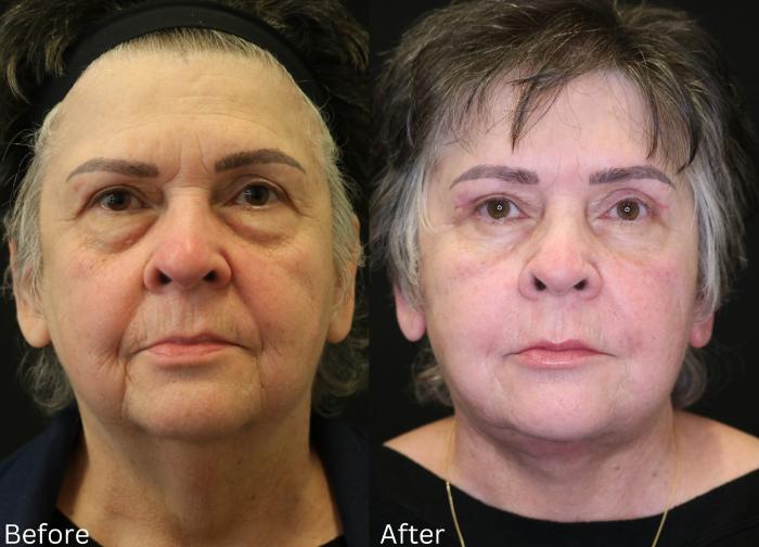 Before & After Facelift & Neck Lift Case 48 View 1 View in Santa Rosa, California