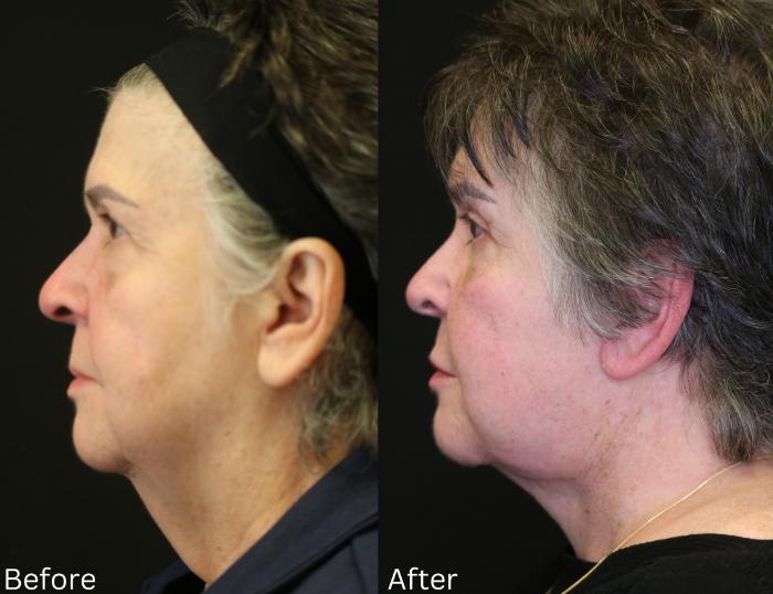 Before & After Facelift & Neck Lift Case 48 View 2 View in Santa Rosa, California