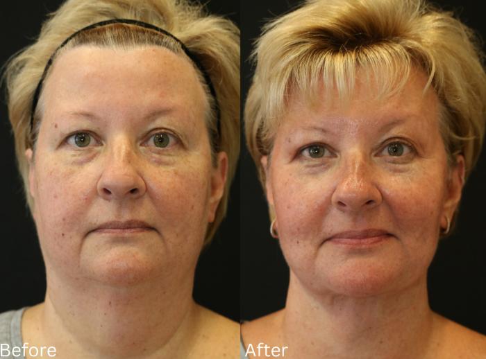 Before & After Facelift & Neck Lift Case 49 View 1 View in Santa Rosa, California