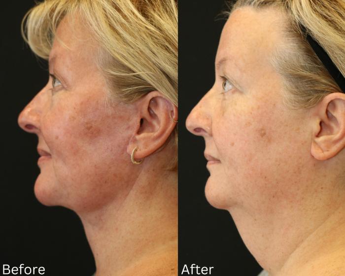 Before & After Facelift & Neck Lift Case 49 View 2 View in Santa Rosa, California