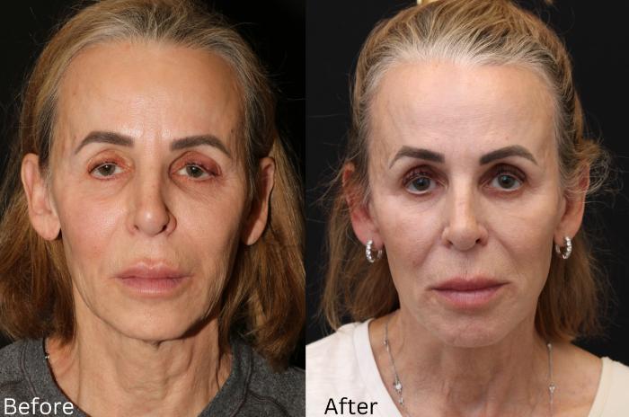 Before & After Facelift & Neck Lift Case 50 View 1 View in Santa Rosa, California
