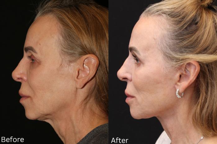 Before & After Facelift & Neck Lift Case 50 View 2 View in Santa Rosa, California