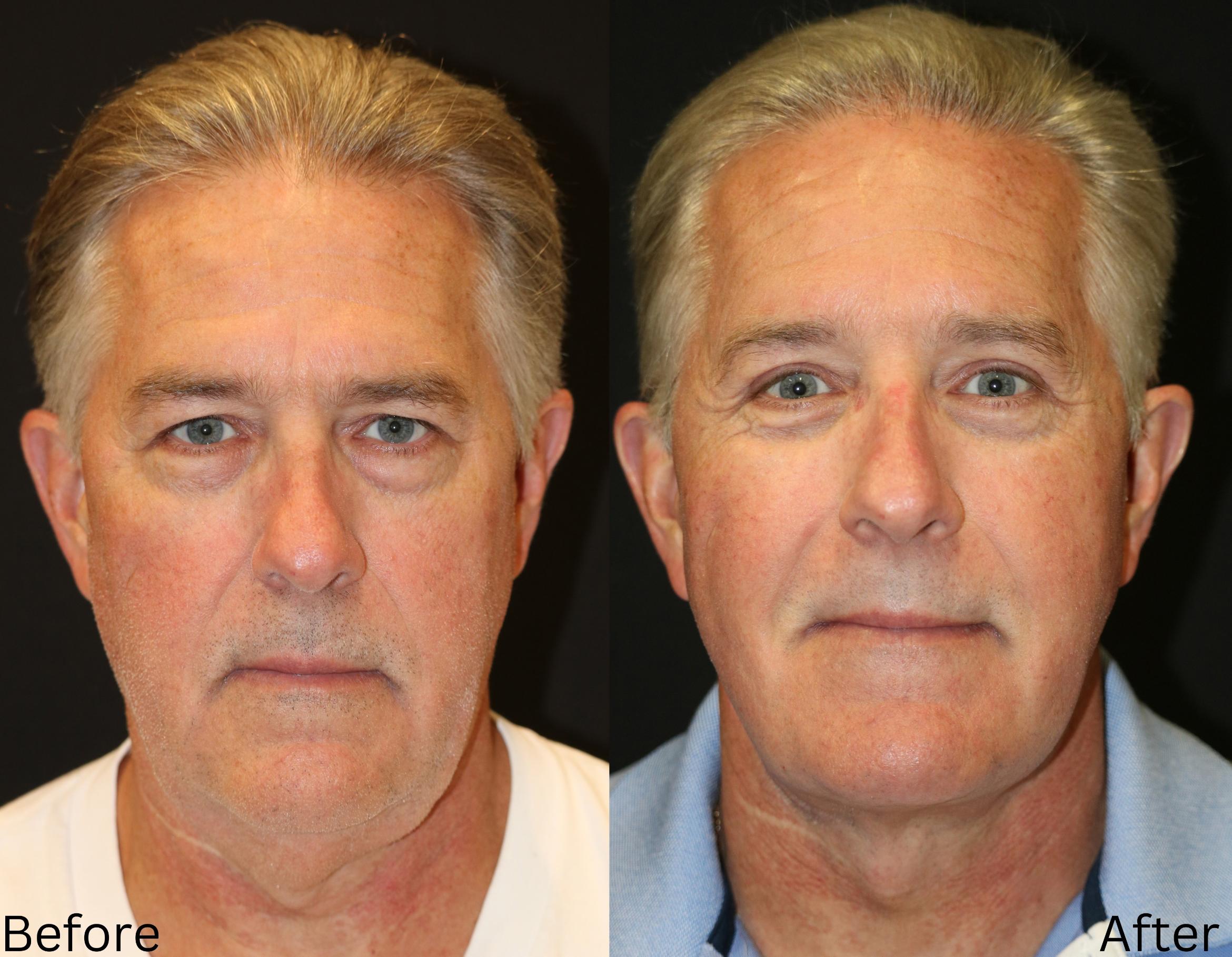 Before & After Facelift & Neck Lift Case 51 View 1 View in Santa Rosa, California