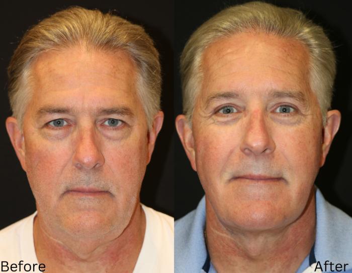Before & After Total Facial Rejuvenation Case 51 View 1 View in Santa Rosa, California