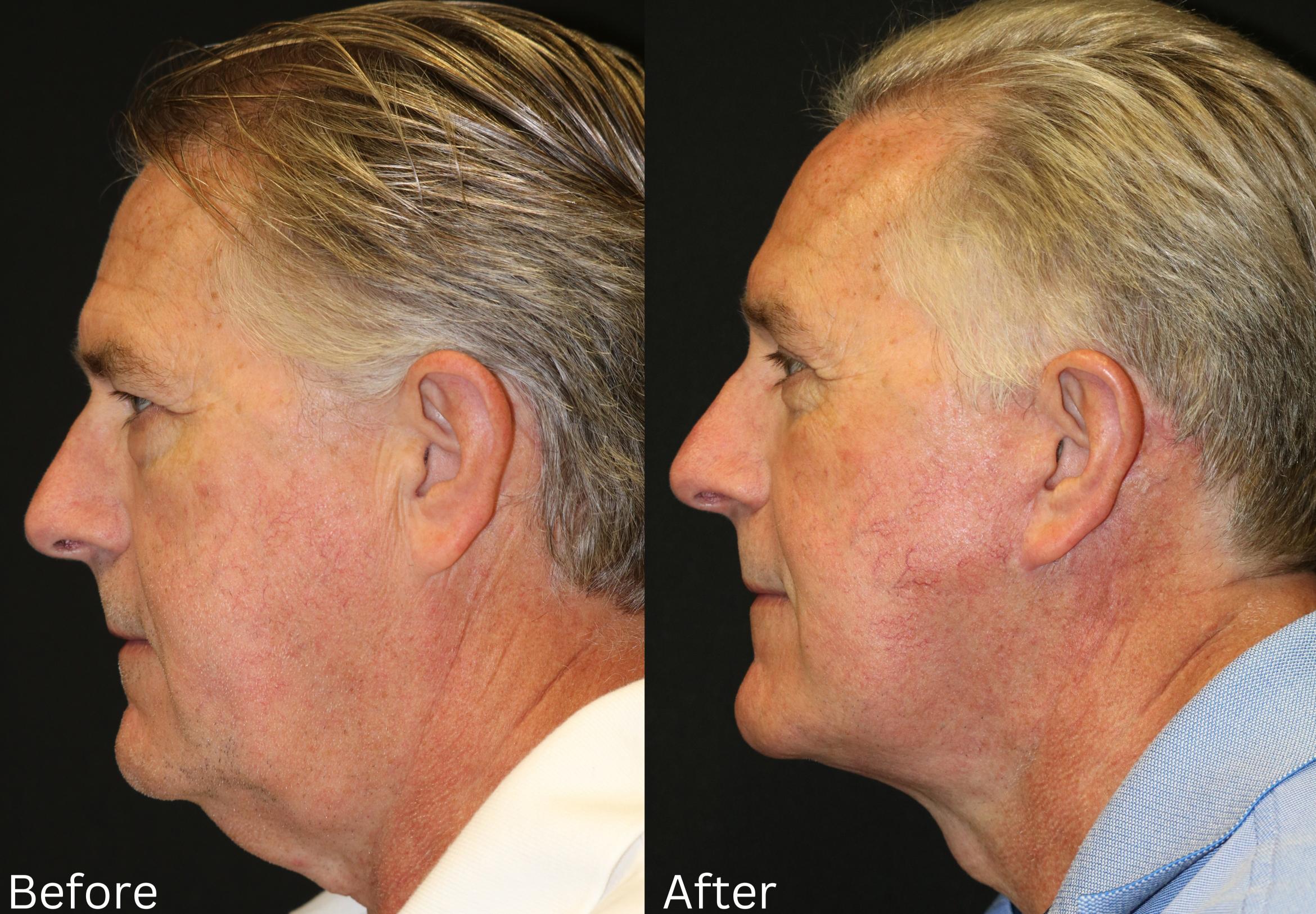 Before & After Facelift & Neck Lift Case 51 View 2 View in Santa Rosa, California