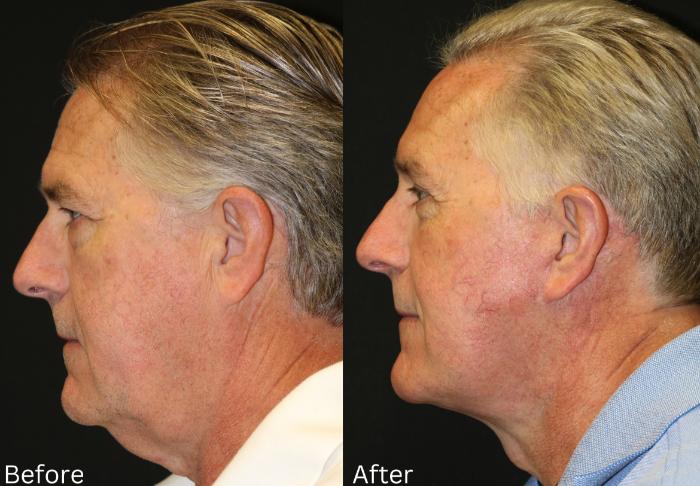 Before & After Facelift & Neck Lift Case 51 View 2 View in Santa Rosa, California
